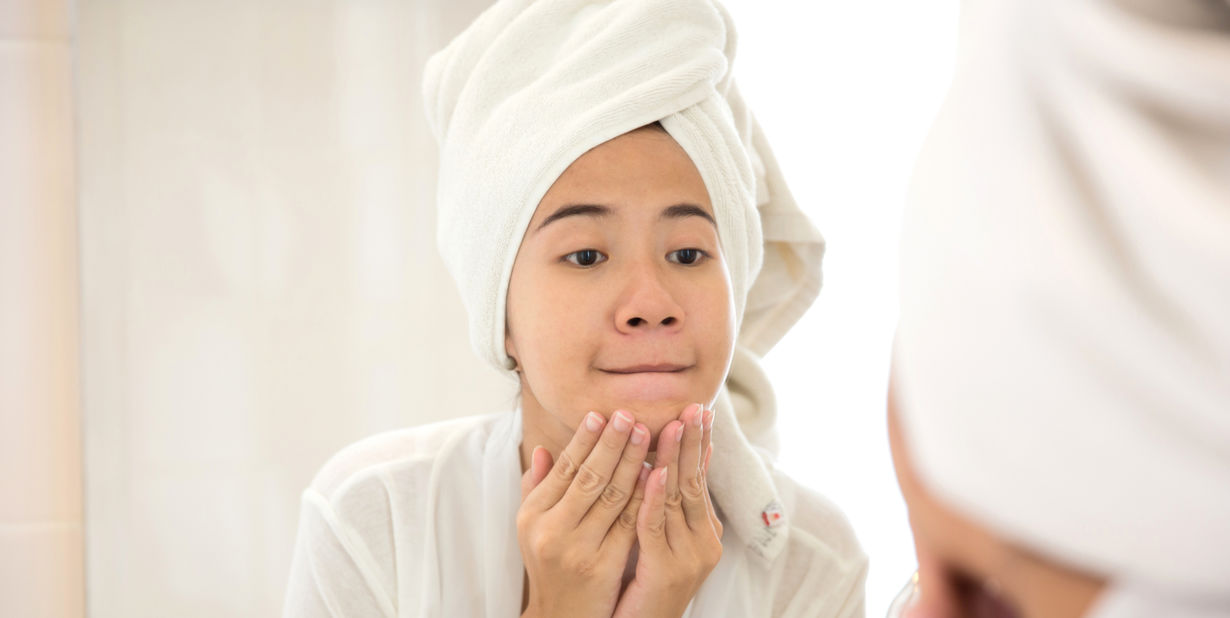 حب الشباب الهرموني