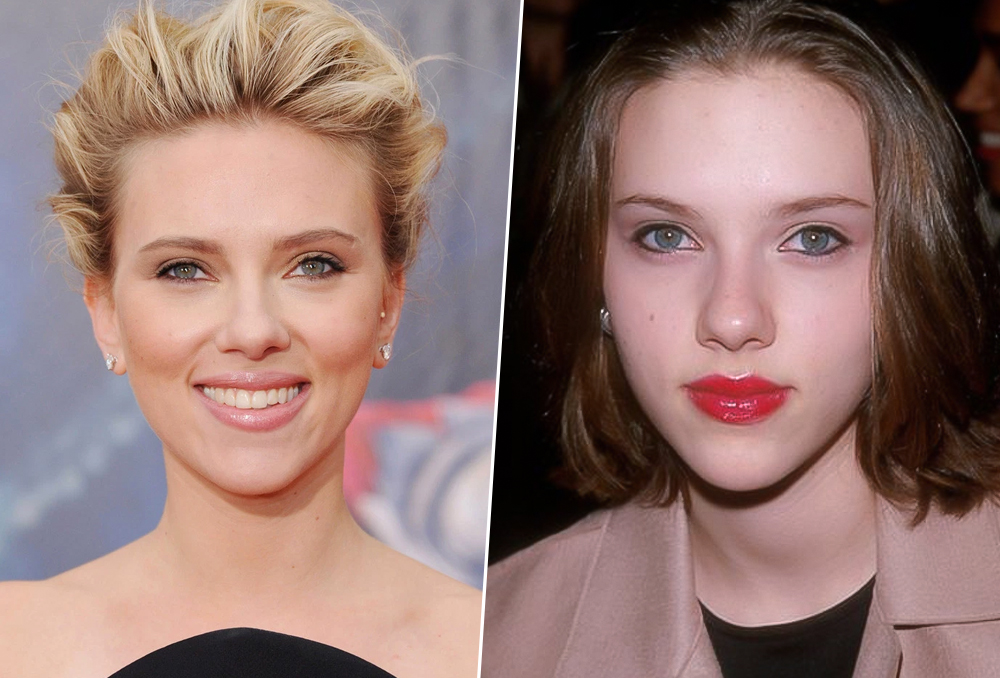 عمليات تجميل الأنف العريض 