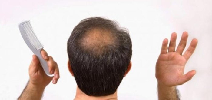 دواء تساقط الشعر من الصيدلية