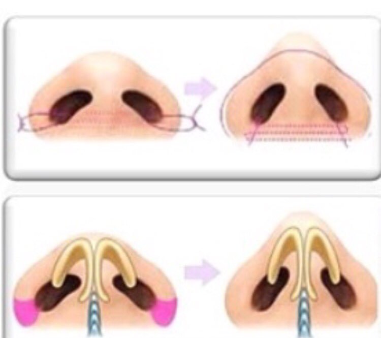 الخيوط الجراحية لتصغير فتحات الأنف