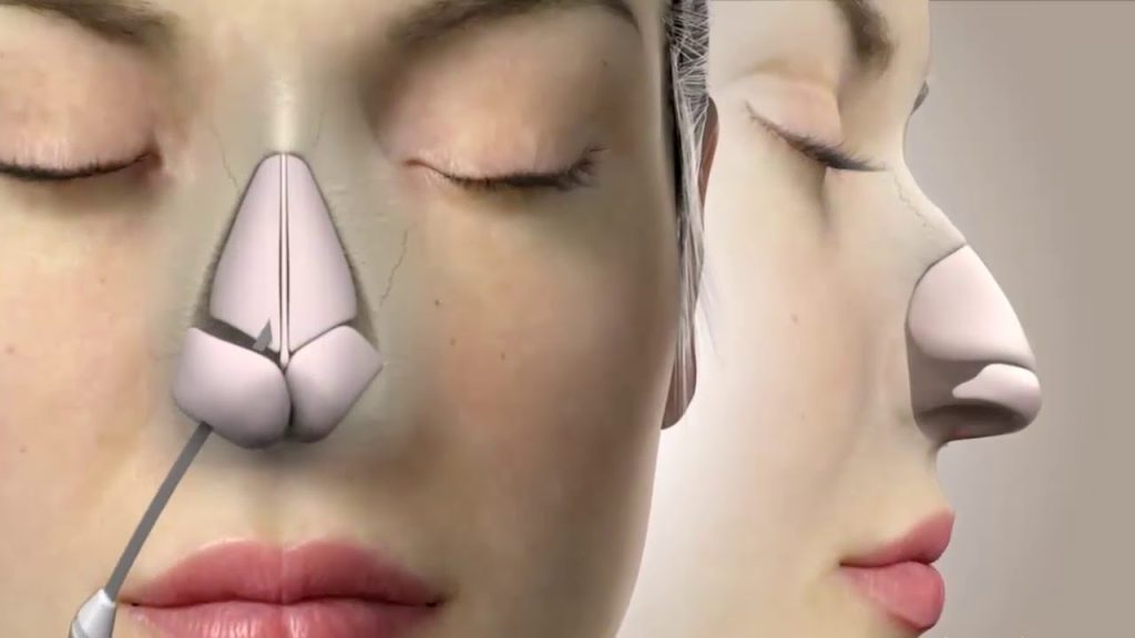 غضروف الأنف بدون عملية