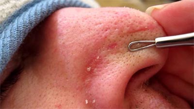 إزالة الرؤوس البيضاء من الأنف