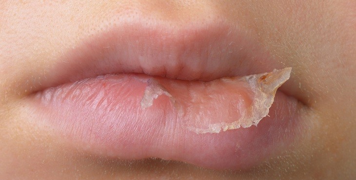 تكبير الشفتين 