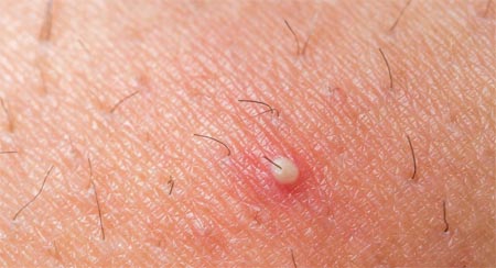 ظهور بثور بيضاء على الوجه