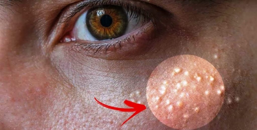 ظهور بثور بيضاء على الوجه