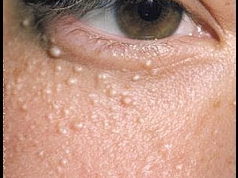 علاج الحبوب البيضاء الصغيرة في الوجه