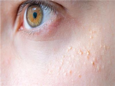 علاج الحبوب البيضاء تحت العين