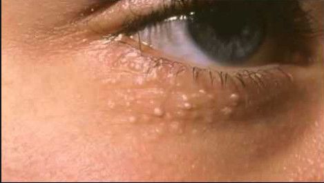 علاج الحبوب البيضاء تحت العين