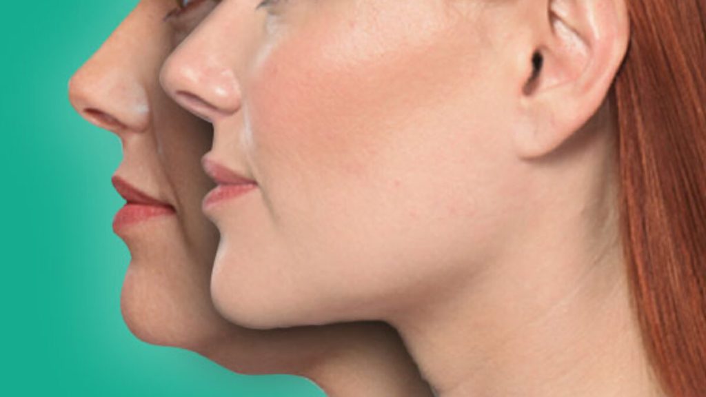 شد الذقن بالليزر