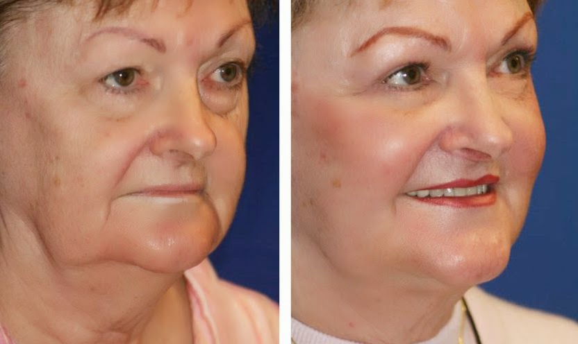 شد الرقبة بشعاع الليزر