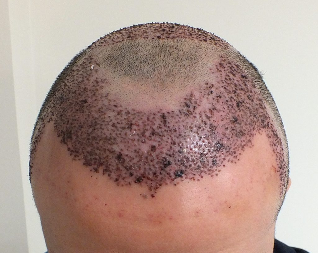 اليوم الخامس بعد زراعة الشعر