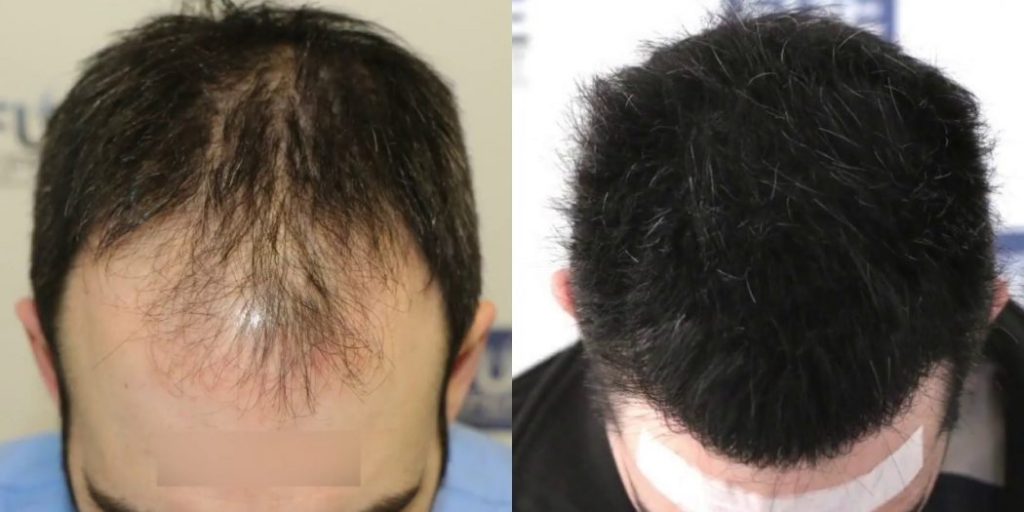 طريقة زراعة الشعر بالاقتطاف