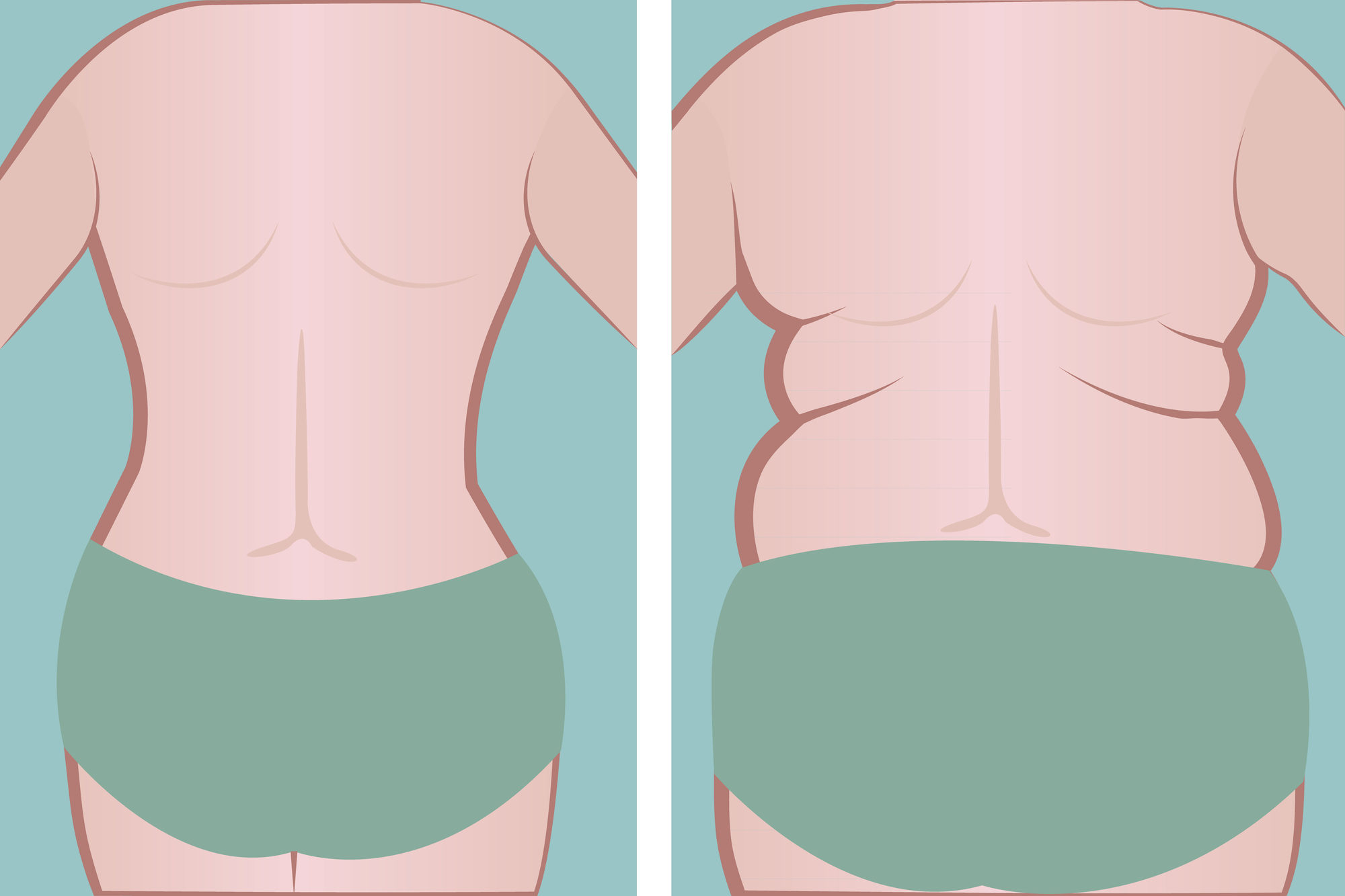 شفط دهون الظهر