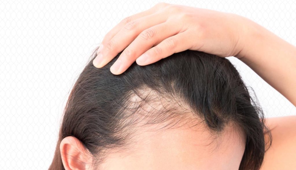 علاج الثعلبة بالقطران مجرب