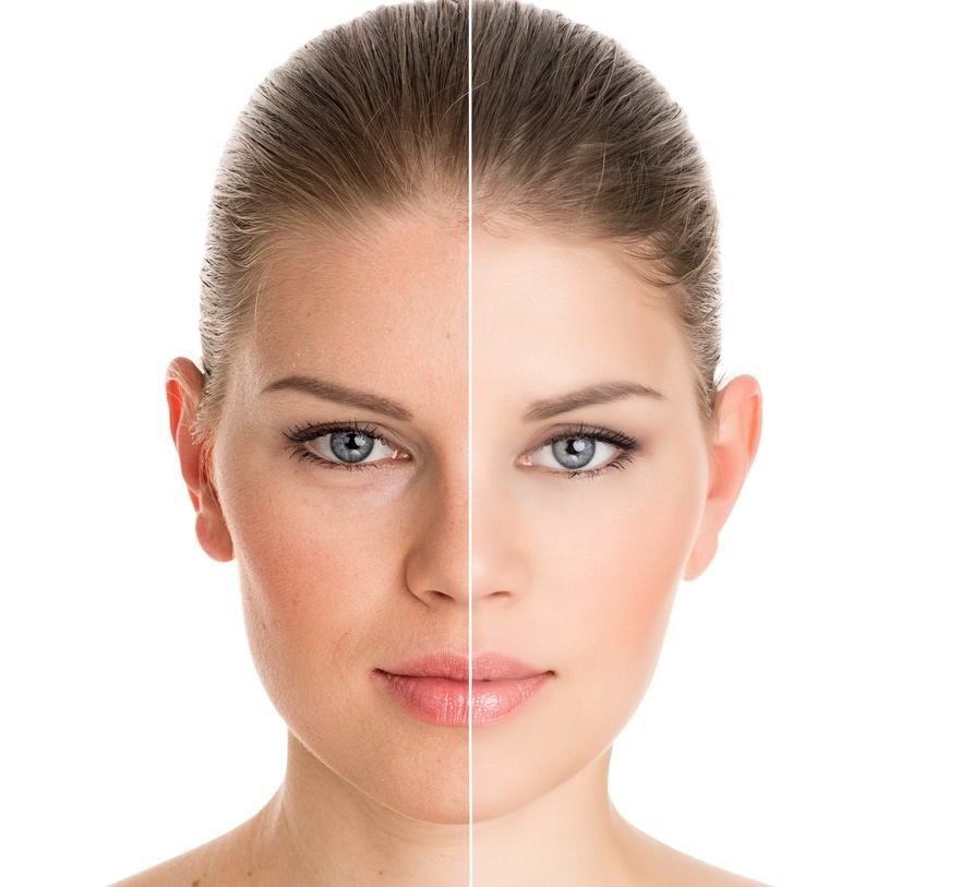 ابرة النضارة للجسم كامل