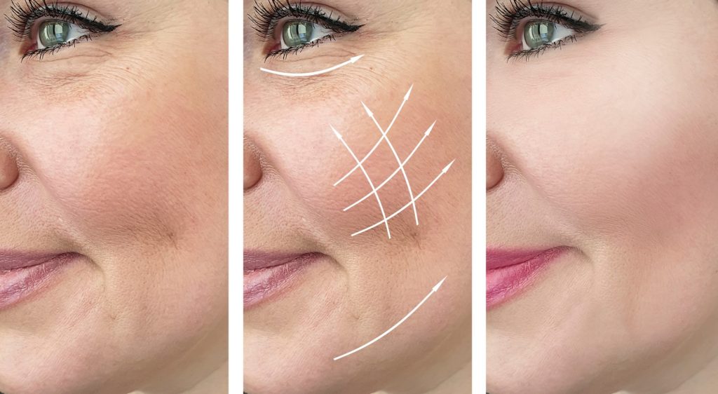 بروفايلو للوجه قبل وبعد