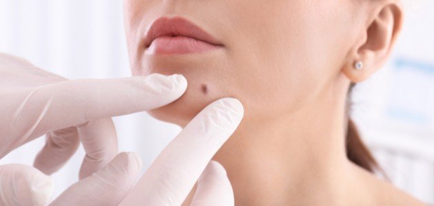 سبب ظهور الشامات أثناء الحمل