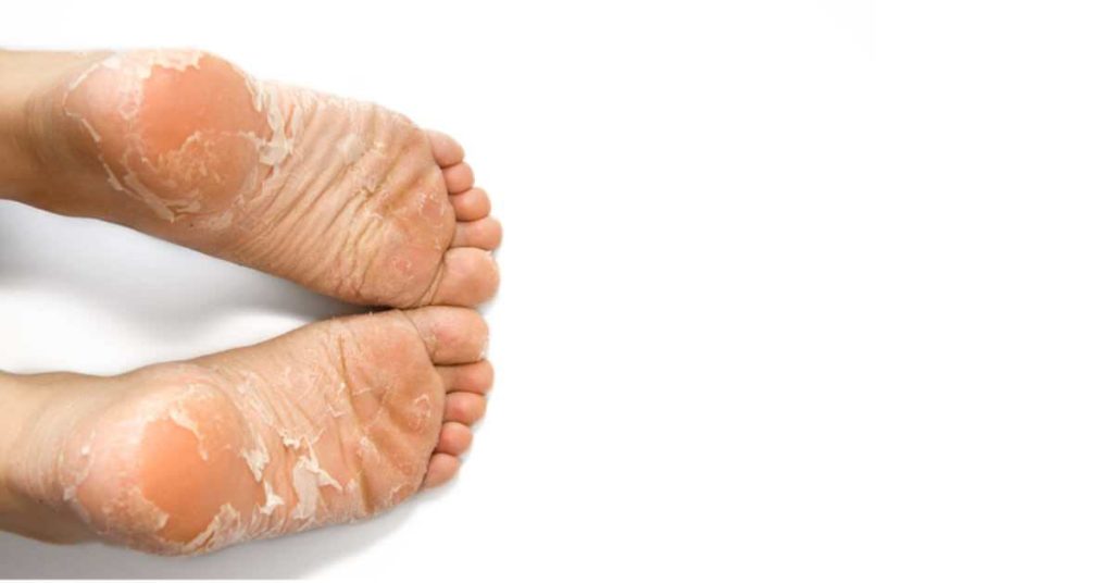 طريقة تنعيم القدمين وإزالة الجلد الميت