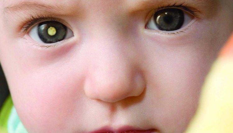 أسباب تبريق العين عند الأطفال
