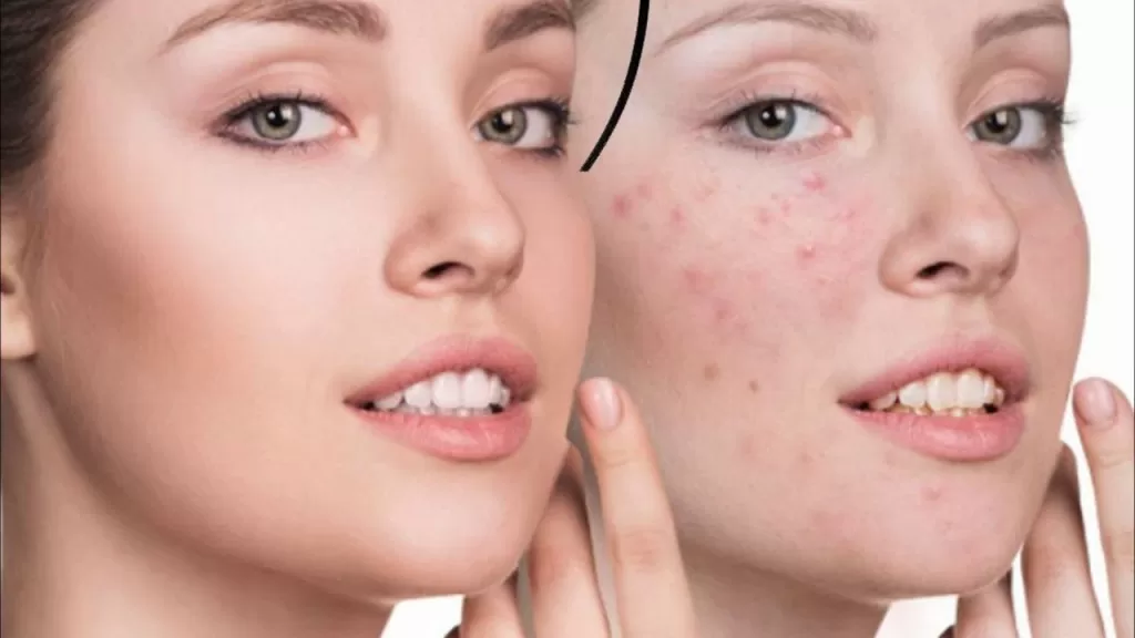 علاج حساسية البشرة في المنزل