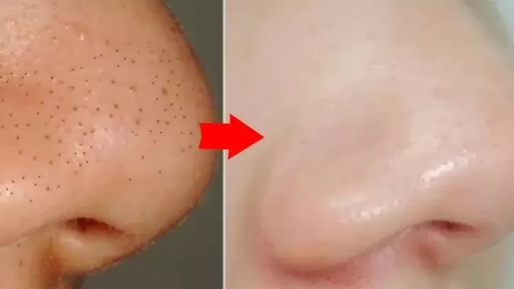 كريم ازالة الرؤوس السوداء لبشرة خالية من العيوب