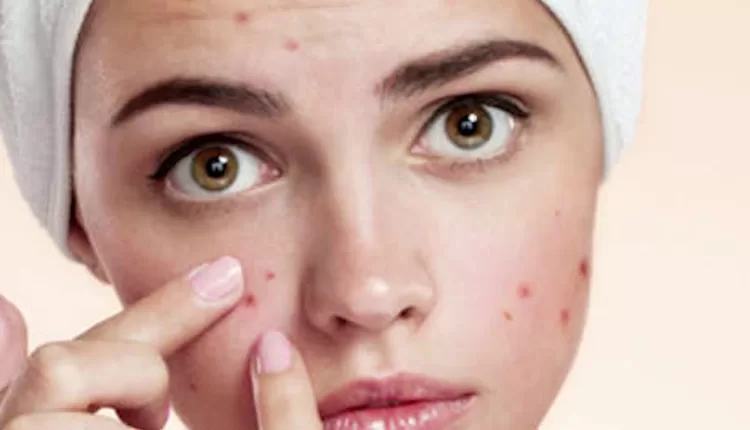 علاج حساسية البشرة في المنزل