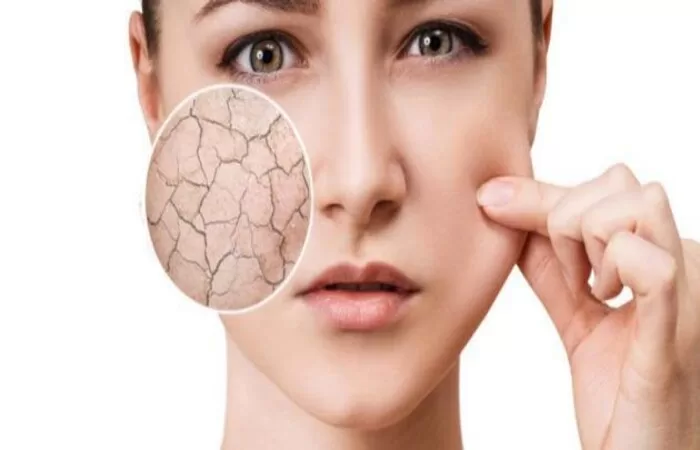 البشرة الجافة