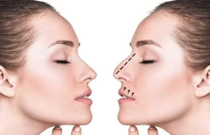 عملية تجميل الانف